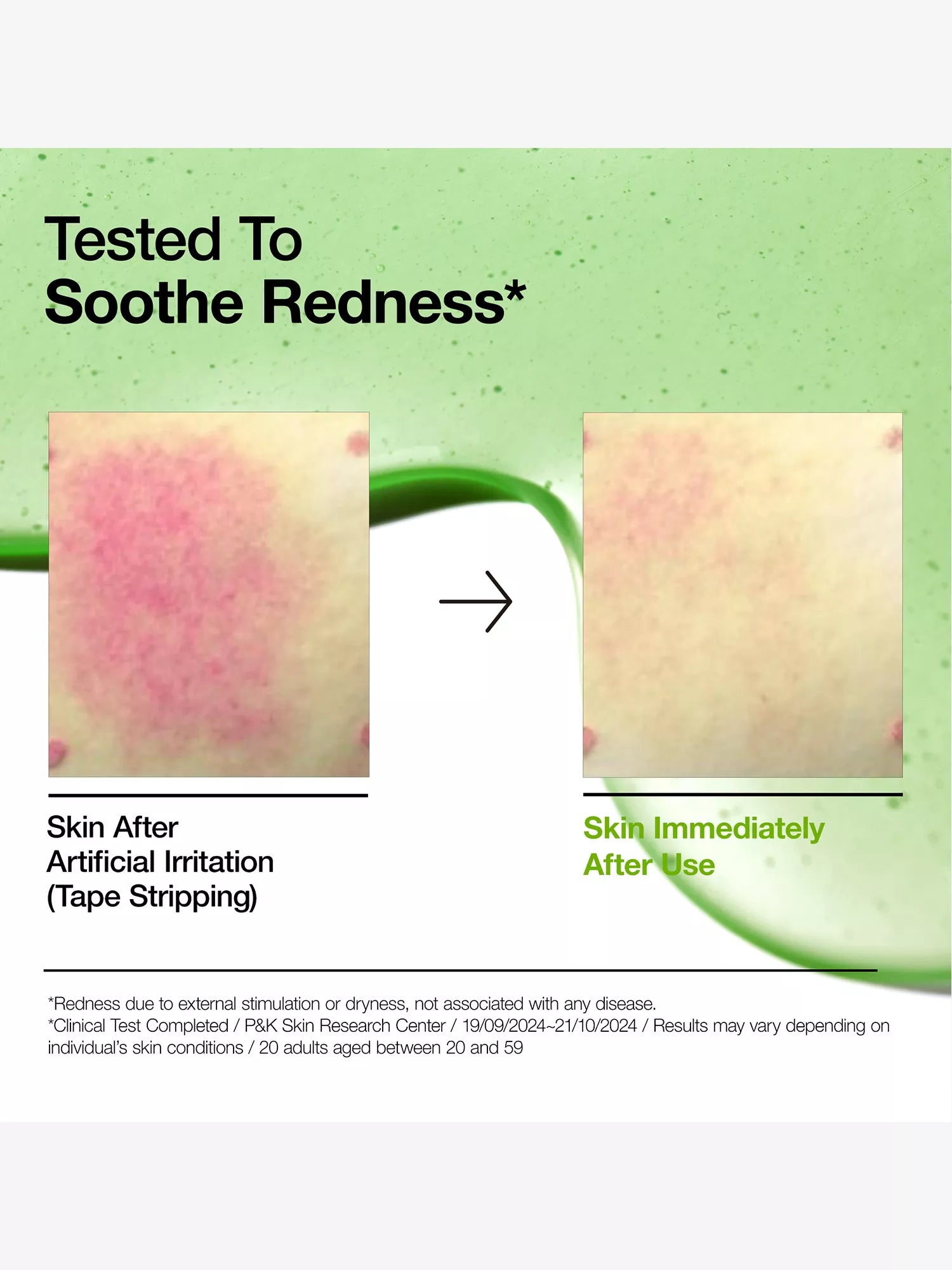 [PRE ORDER] BOGO Anua Azelaic Acid 10+ Hyaluron 30ml